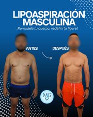 La lipoaspiración masculina - Dr. Maximiliano Gil Miranda