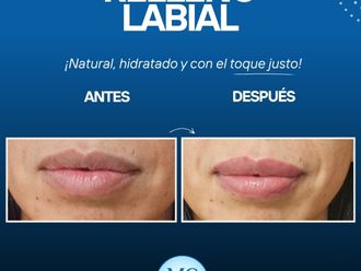Relleno de labios antes y después - 877461