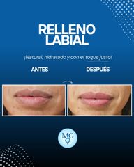 El relleno labial con ácido hialurónico - Dr. Maximiliano Gil Miranda