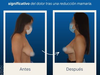 Reducción de mamas antes y después - 877462