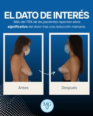 Reducción Mamaria - Dr. Maximiliano Gil Miranda