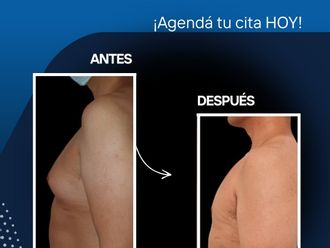 Ginecomastia antes y después - 877464