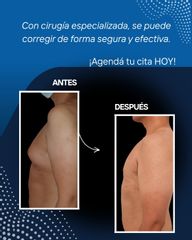 Ginecomastia - Dr. Maximiliano Gil Miranda