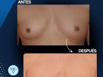 Ginecomastia antes y después - 877465