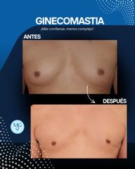 Ginecomastia - Dr. Maximiliano Gil Miranda