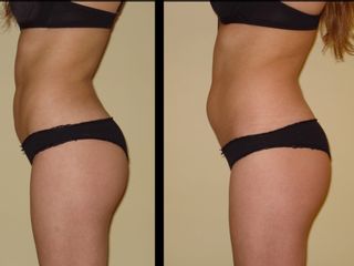 Lipoaspiración