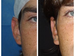 Auriculoplastia