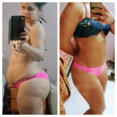 Abdominoplastia