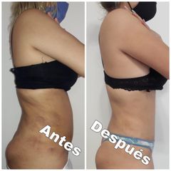 Liposucción - Dr. Jose Luis Moretti