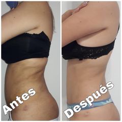 Liposucción - Dr. Jose Luis Moretti