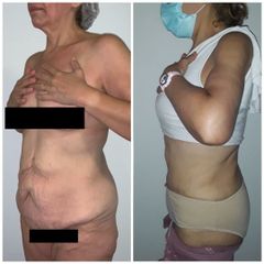 Dermolipectomía + Reconstrucción Abdomen (diástasis. hernia) - Dr. Jose Luis Moretti