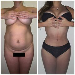Dermolipectomía - Dr. Jose Luis Moretti