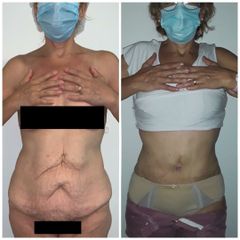 Dermolipectomía + Reconstrucción Abdomen (diástasis. hernia) - Dr. Jose Luis Moretti