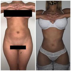 Liposucción - Dr. Jose Luis Moretti