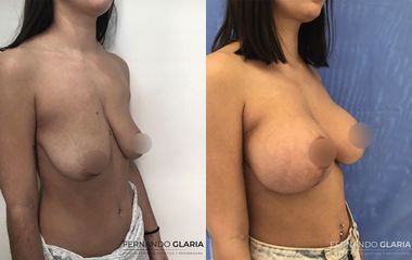 Mastopexia - Dr. Fernando Glaria