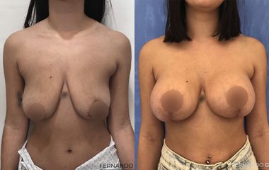Mastopexia - Dr. Fernando Glaria