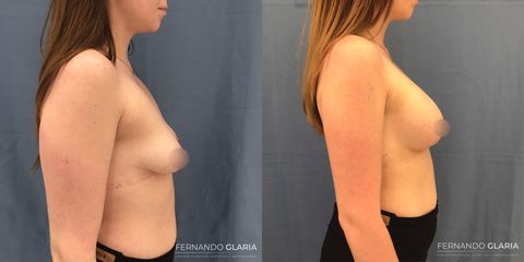 Mastopexia - Dr. Fernando Glaria