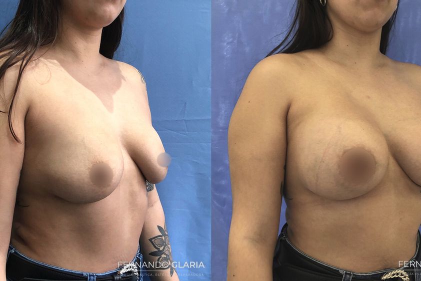 Mastopexia antes y después - 741617