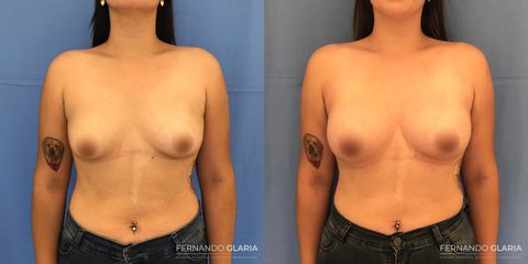 Aumento mamas - Dr. Fernando Glaria