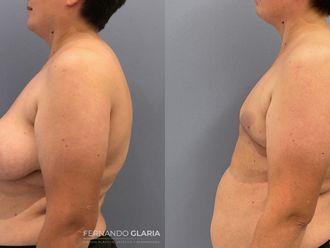 Reasignación de sexo antes y después - 793605