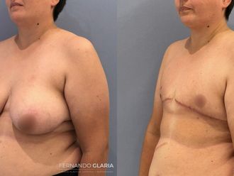 Reasignación de sexo antes y después - 793606