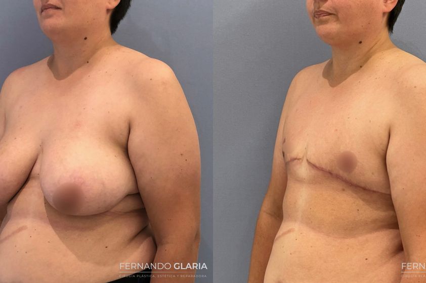 Reasignación de sexo antes y después - 793606