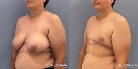 Mastectomía por Reasignación de Género - Dr. Fernando Glaria