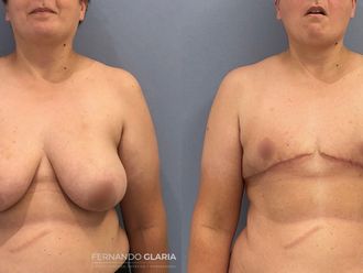 Reasignación de sexo antes y después - 793607
