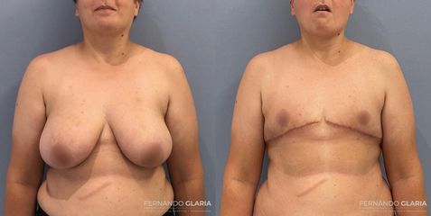 Mastectomía por Reasignación de Género - Dr. Fernando Glaria