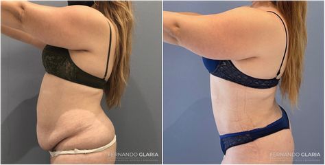 Abdominoplastia - Dr. Fernando Glaria