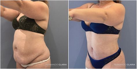 Abdominoplastia - Dr. Fernando Glaria