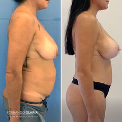 Mastopexia - Dr. Fernando Glaria