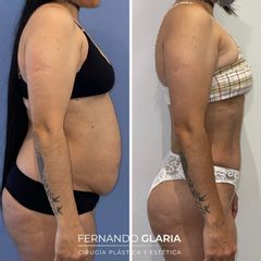 Abdominoplastia - Dr. Fernando Glaria