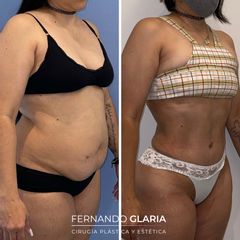 Abdominoplastia - Dr. Fernando Glaria