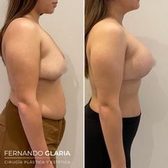 Mastopexia - Dr. Fernando Glaria