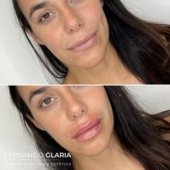 Relleno de labios - Dr. Fernando Glaria