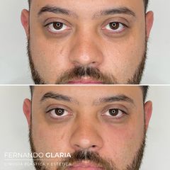Eliminación de ojeras - Dr. Fernando Glaria