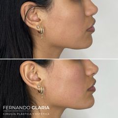 Mentón y contorno mandibular - Dr. Fernando Glaria