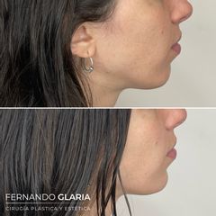 Mentón y contorno mandibular - Dr. Fernando Glaria