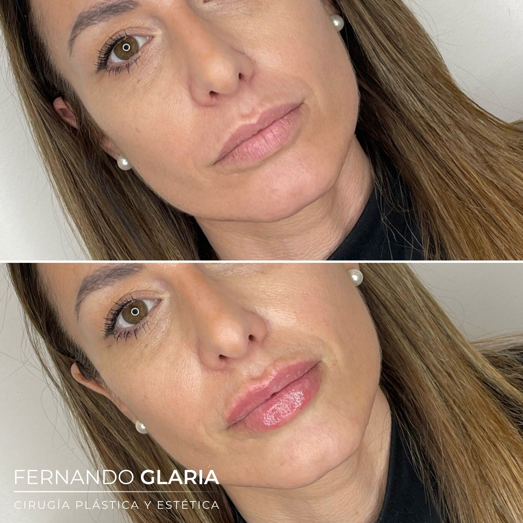 Antes Y Después - Esteticas.com.ar - Esteticas.com.ar