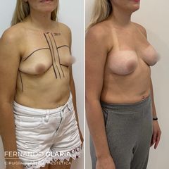 Aumento mamas - Dr. Fernando Glaria