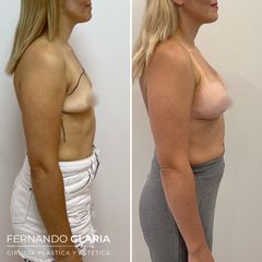 Aumento mamas - Dr. Fernando Glaria