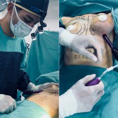 Aumento Mamas - Dr. Fernando Glaria