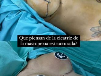 Mastopexia antes y después - 880537