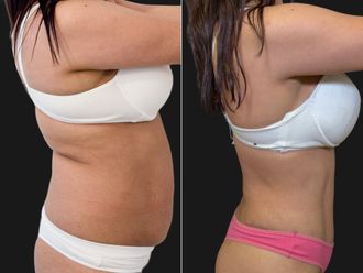Abdominoplastía antes y después - 881187