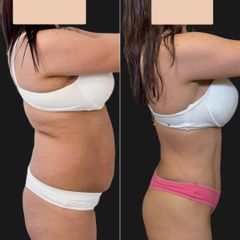 Abdominoplastia- Dr. Fernando Glaria