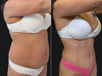 Abdominoplastía antes y después - 881188