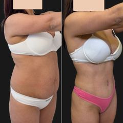 Abdominoplastia - Dr. Fernando Glaria