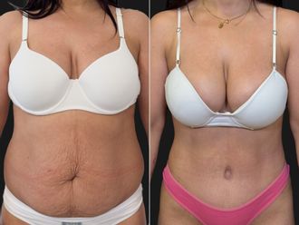 Abdominoplastía antes y después - 881189