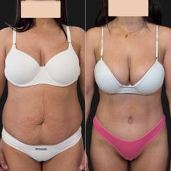 Abdominoplastia - Dr. Fernando Glaria